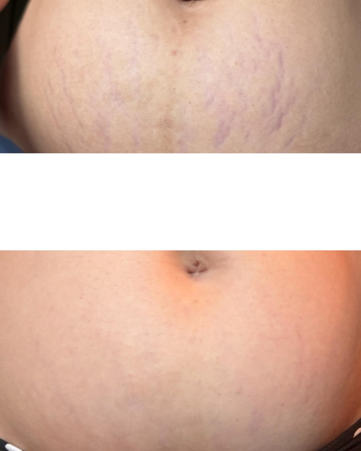 TriLASTIN Stretch Mark Cream - Collagen & Elastin Support Body Cream with Niacinamide, Vitamin C & Vitamin E - Hydrating Stretch Mark Lotion for Belly, Hips & Thighs - Unscented - 5.5 oz customer photo 1