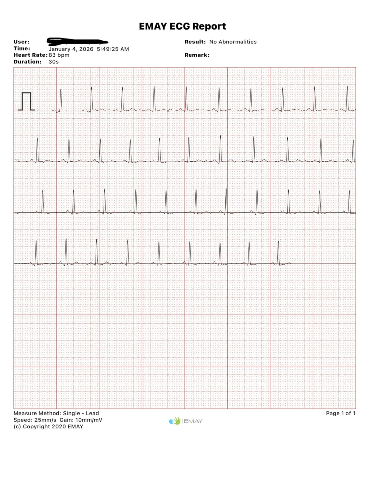EMAY Portable ECG Monitor | Record ECG and Heart Rate | Compatible with Smartphone and PC customer photo 2