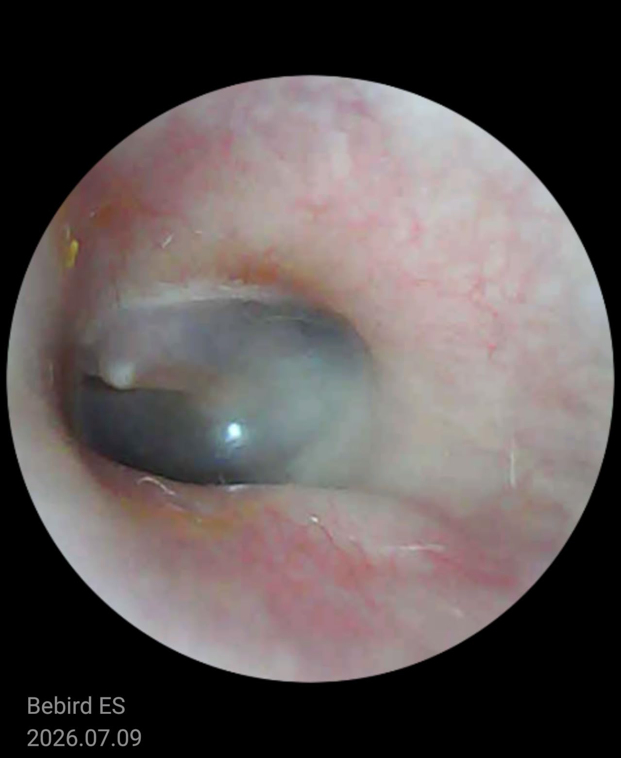 Bebird D39R Ear Wax Removal: Ear Camera with Storage Case & Painless Tweezers, 12 Earwax Removal Tips, Anti-Insert Guard (Blue) customer photo 2