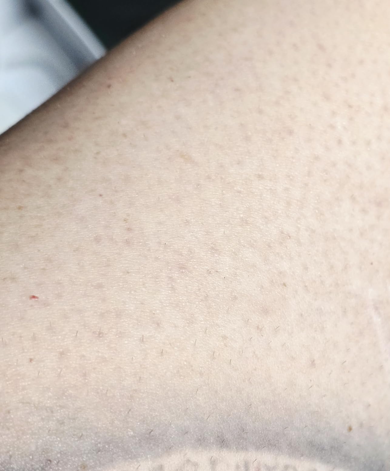 Finequin Laser Hair Removal for Women & Men, 45°F Ice-Cooling Contact, Safe & Virtually Painless Alternative to Salon IPL Hair Removal Device, Long-Lasting Hair Removal from Home, with Razor & Glasses customer photo 1