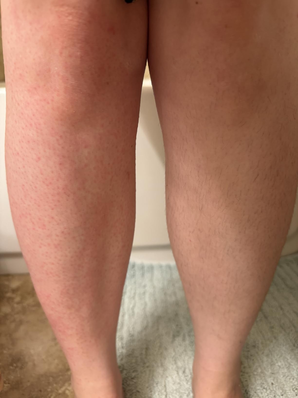 Philips Epilator Series 2000, Corded Epilator for Legs and Body, Hair Removal Device for Women, Model BRE227/00 customer photo 1